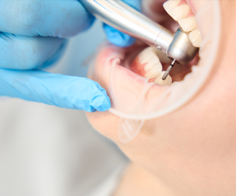 Fillings Covered by CDCP in Barrie, ON