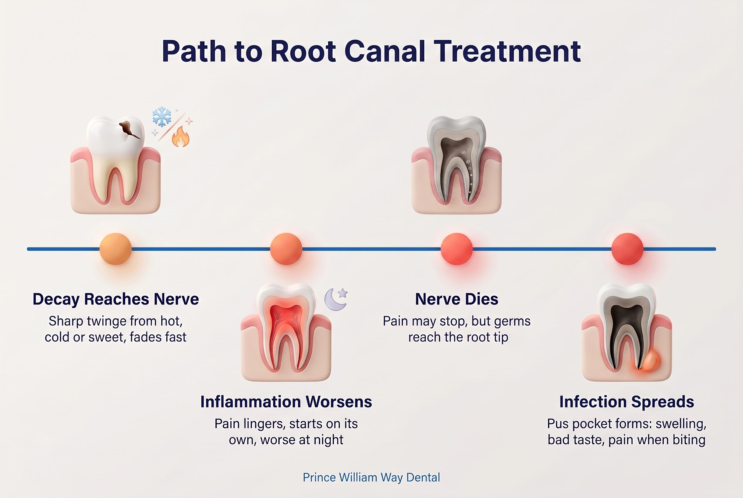 Horizontal timeline of pulp disease progression, from healthy tooth to an irritated nerve that can recover, inflammation past healing, a dead nerve, and an infection pocket (abscess) at the root tip.